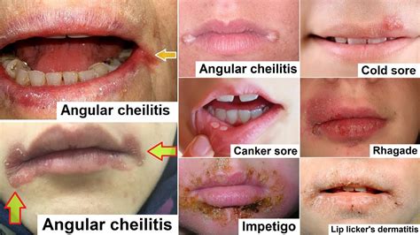 queilitis angular|Angular Chelitis